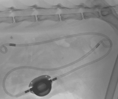 SUB — Subcutaneous Ureteral ByPass — Movora